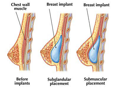 Breast Augmentation Hawaii