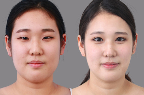 Hawaii Eyelid Surgery - blepharoplasty