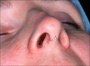 Rhinoplasty "Nose Job" Surgery