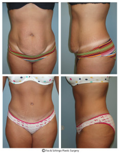 Tummy Tuck Abdominoplasty